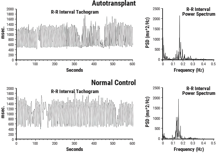 Heart Rhythms Generated by a Transplanted Heart