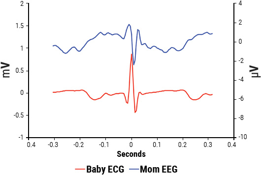 Overlay of signal-averaged EEG and ECG