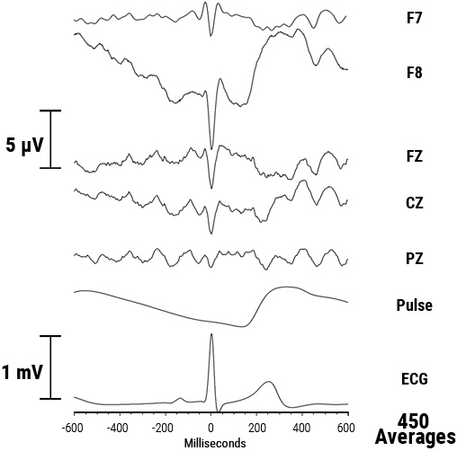 Heartbeat-evoked potentials