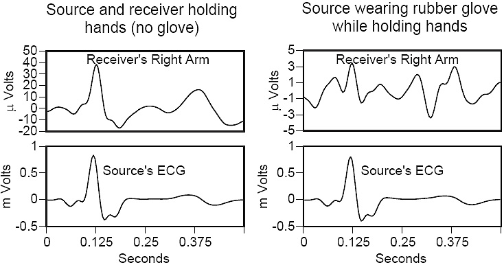 Cardiac signal averaged waveforms