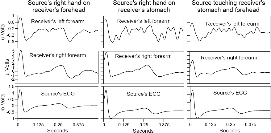 Cardiac signal averaged waveforms