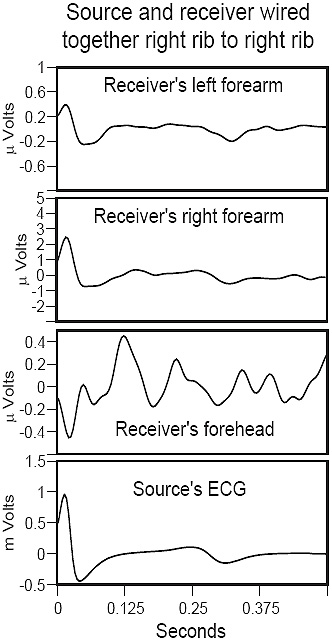 Cardiac signal averaged waveforms