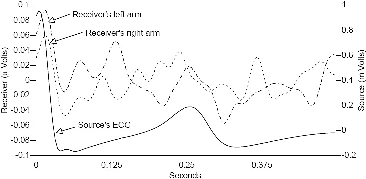 Cardiac signal averaged waveforms
